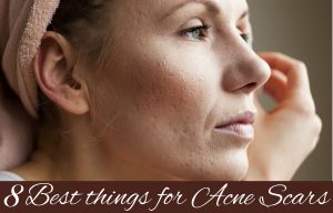 8 Best Things for Acne Scars